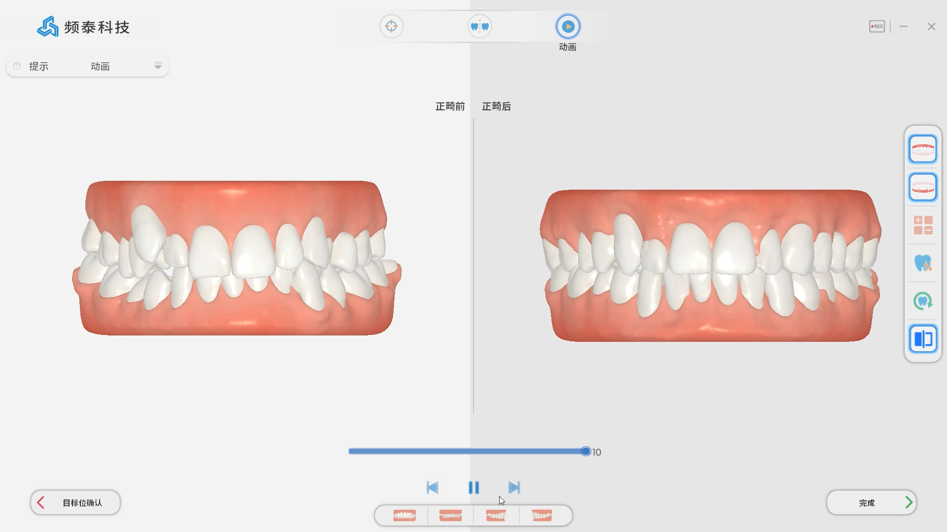 Mise à niveau intelligente de simulation orthodontique du scanner Panda