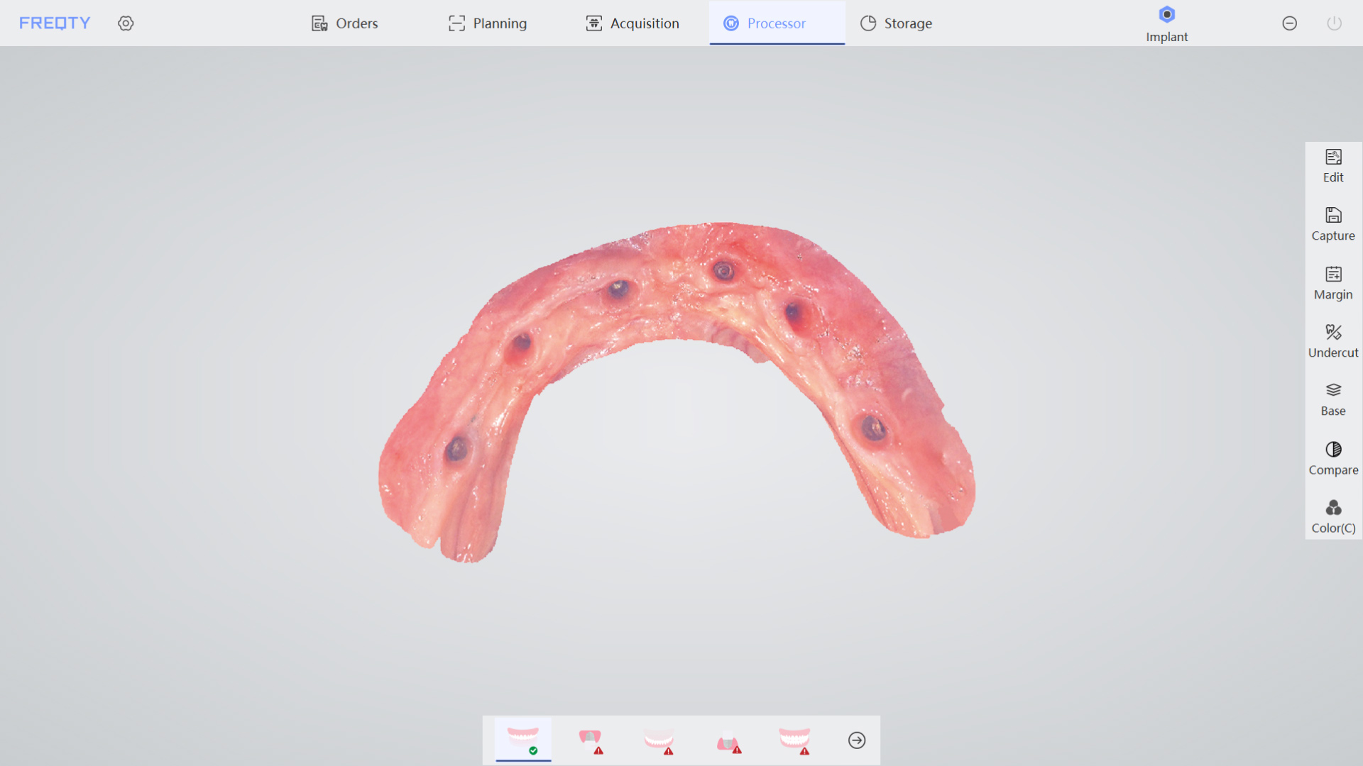 Implantation 1