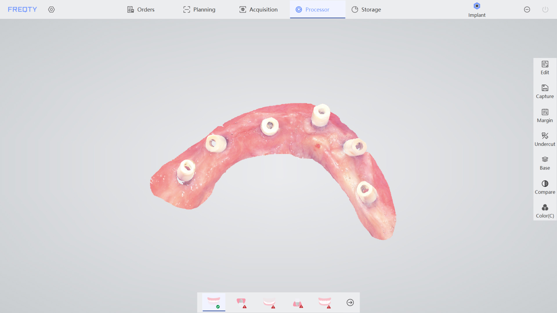 Implantation 2