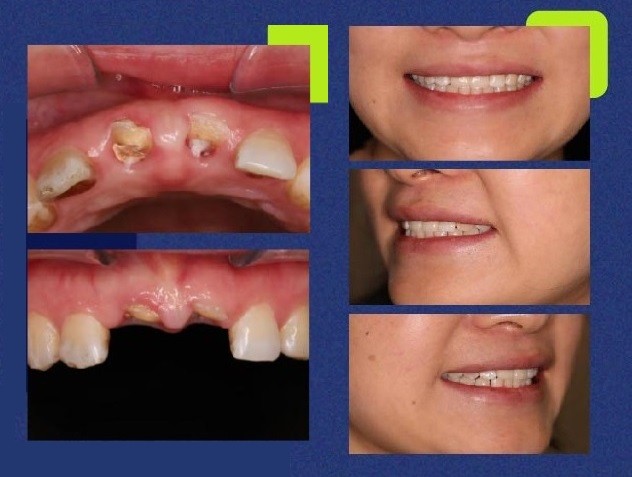 Restauração estética de extrações e implantes de dentes anteriores